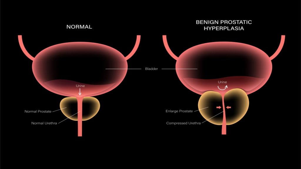 Benign Prostatic Hyperplasia (BPH): Symptoms And Treatment